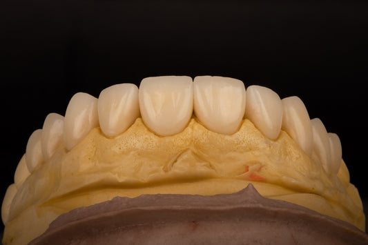 Carillas dentales